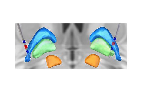 3D reconstruction showing the ECoG contacts targeting the primary motor and premotor cortices in the brain and depth electrodes targeting the globus pallidus..